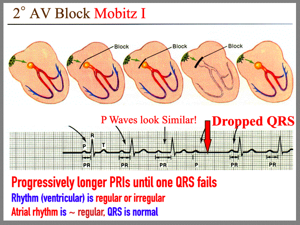 AV Blocks