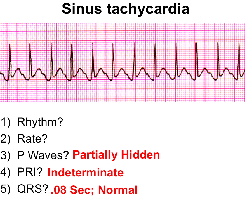 Sinus Tachycardia And Atrial Tachycardia