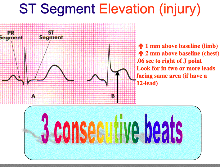 ST Elevation