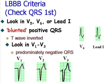 Lbbb Ekg