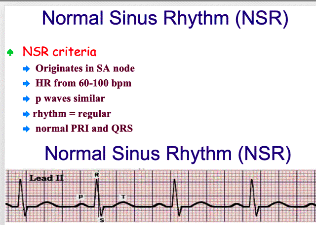 Define Sinus Rhythm On Ecg Hotsell Www jkuat ac ke