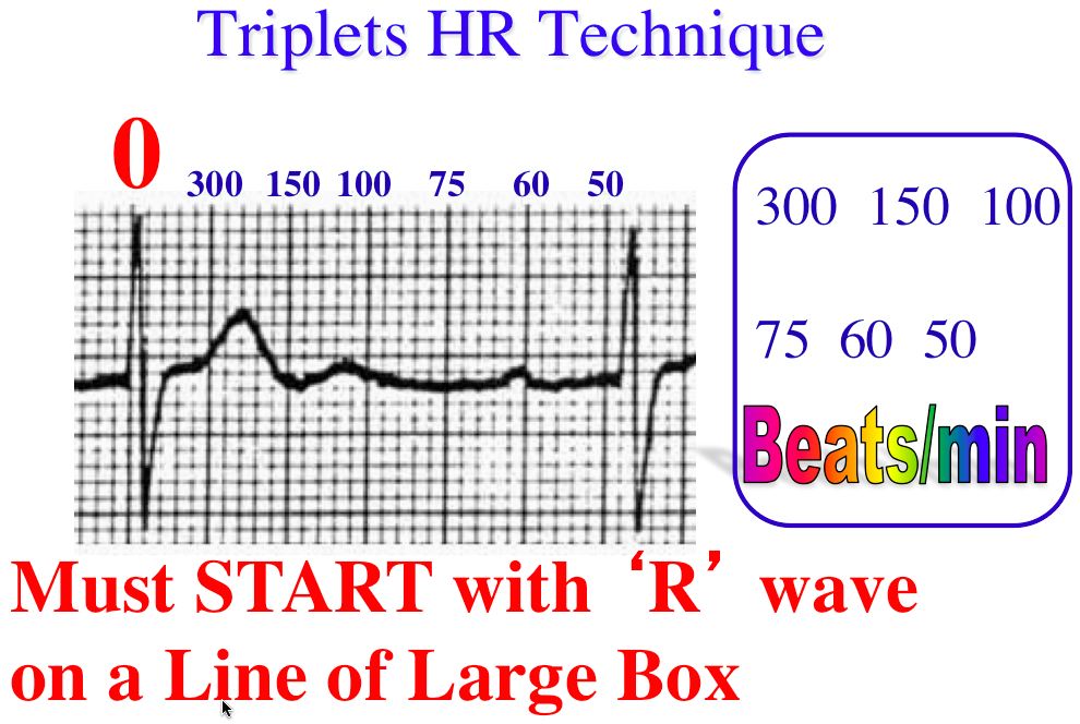 Triplets R To R 6 Second Heart Rate Method