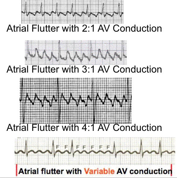 Atrial Flutter