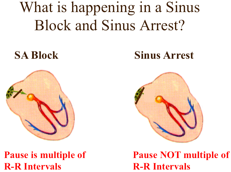 SA Block And Sinus Arrest