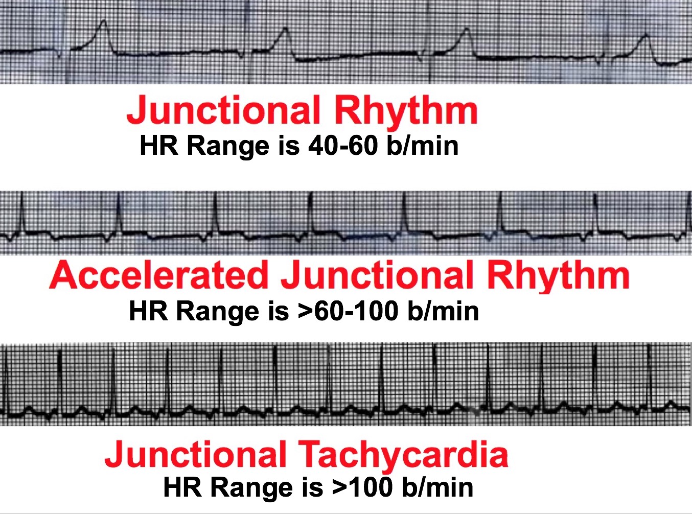 Junctional Rhythms