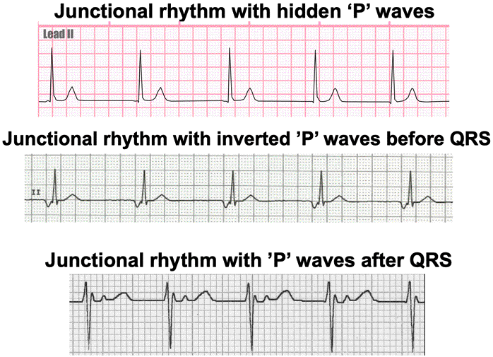 Junctional Rhythms