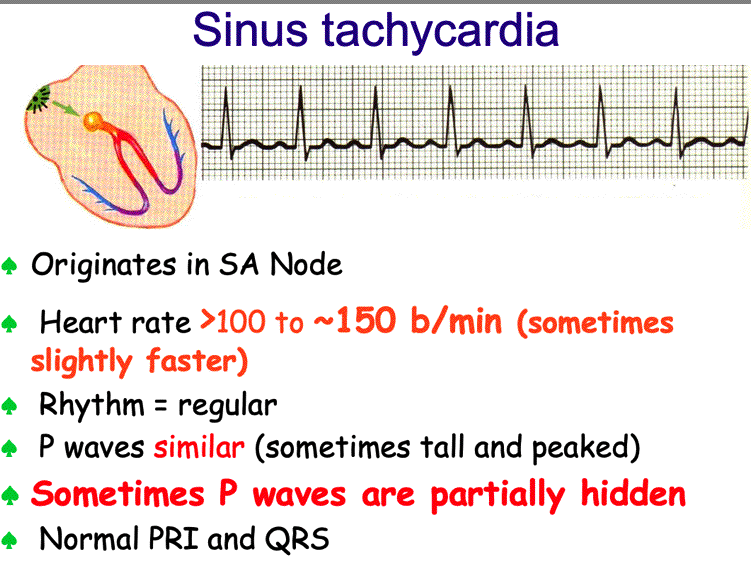Sinus Tachycardia and Atrial Tachycardia