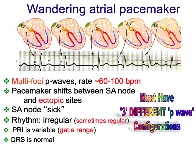 wandering atrial pacemaker vs sick sinus syndrome