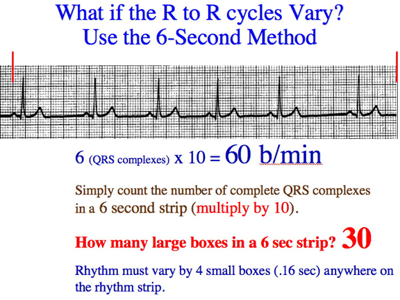 Triplets R To R 6 Second Heart Rate Method